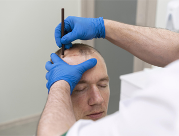 HAIR RESTORATION